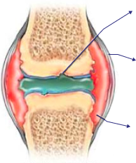 Damaged knee joint