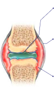 Damaged knee joint